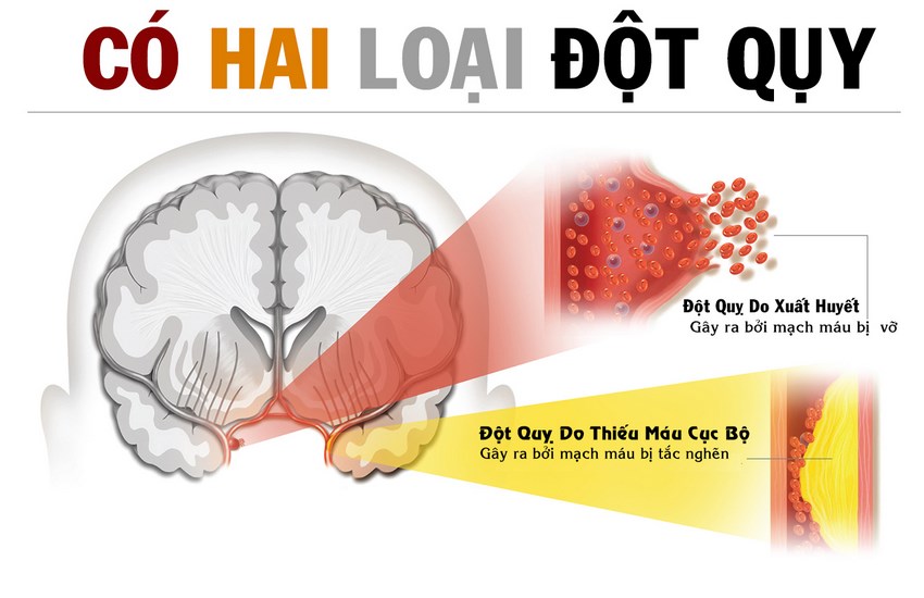 Nguyên nhân tai biến mạch máu não
