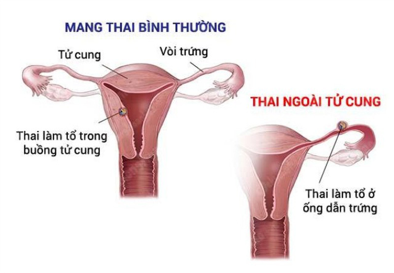 Nguyên nhân kinh nguyệt không đều