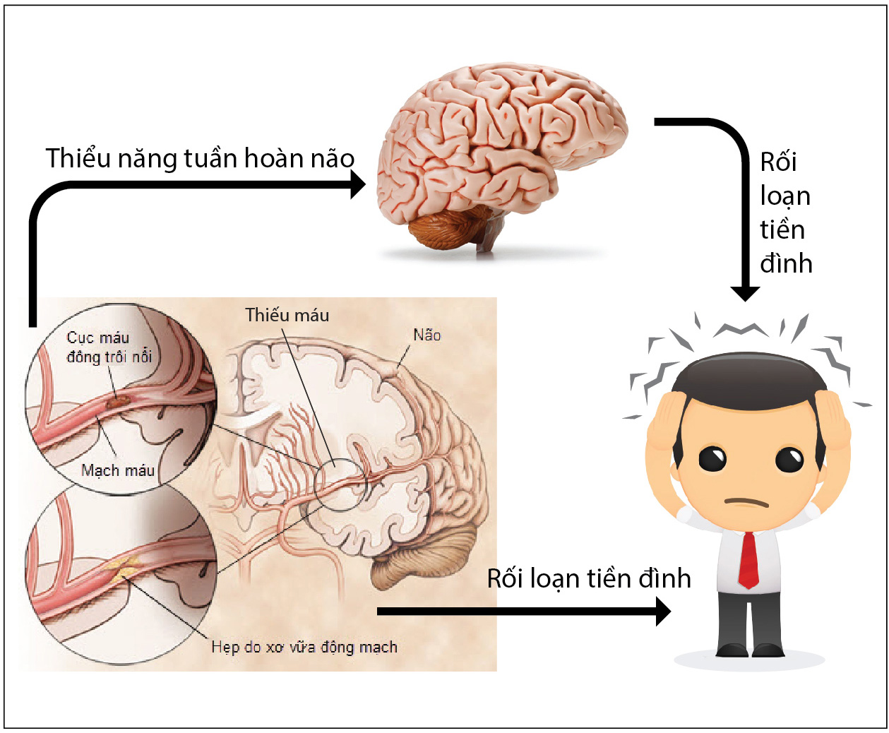 Nguyên nhân rối loạn tiền đình là gì và cách khắc phục ra sao