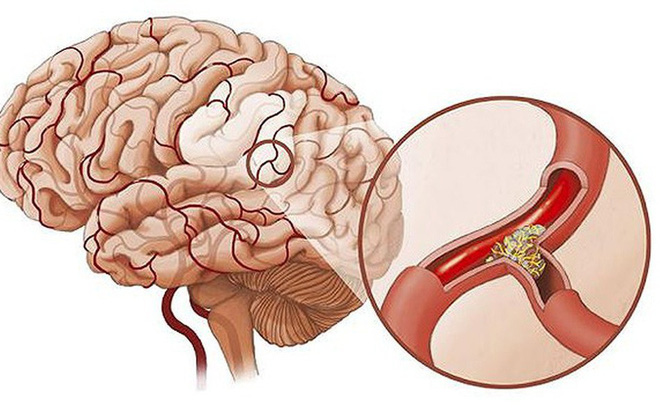 Nguyên nhân rối loạn tiền đình là gì và cách khắc phục ra sao