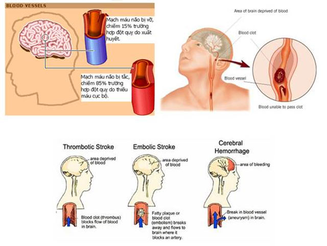 Nguyên nhân tai biến mạch máu não là gì và cách phòng bệnh ra sao