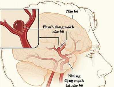 Nguyên nhân tai biến mạch máu não là gì và cách phòng bệnh ra sao