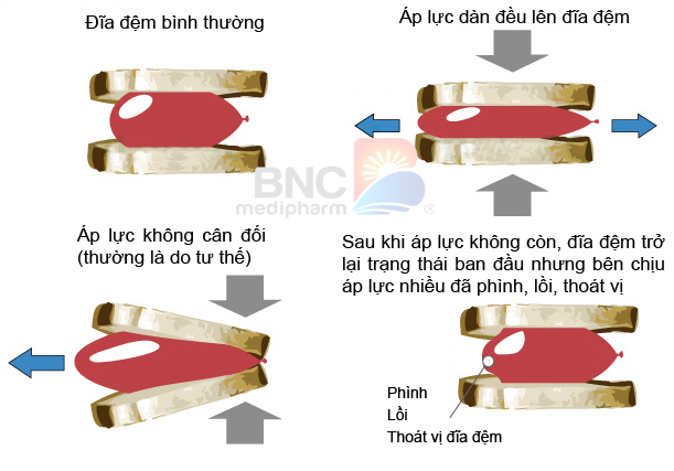 Phồng đĩa đệm có nguy hiểm không