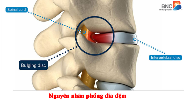 Phồng đĩa đệm có nguy hiểm không