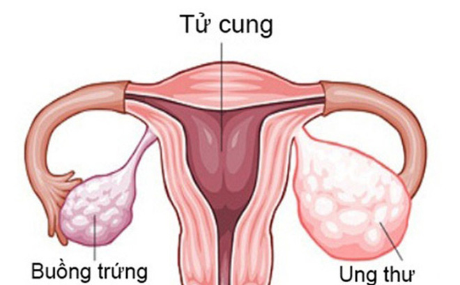 Nguyên nhân ung thư buồng trứng như thế nào