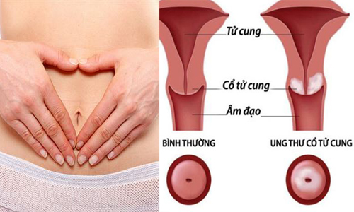 Nguyên nhân ung thư cổ tử cung là gì và cách phòng bệnh ra sao