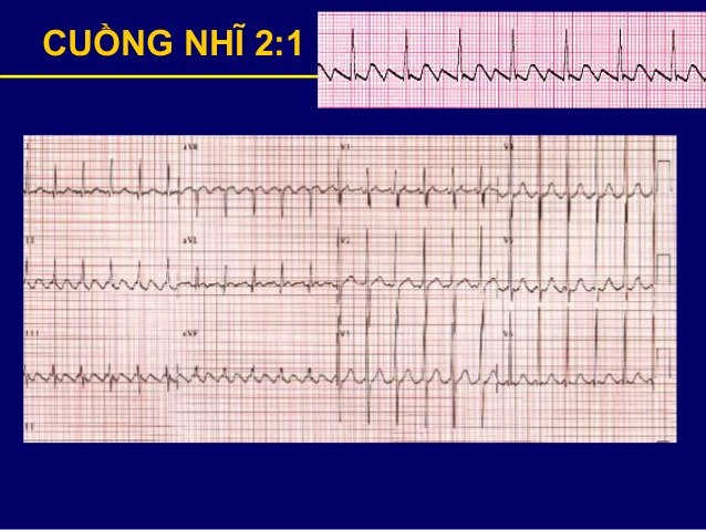 Nhịp tim đập nhanh là bệnh gì và cách khắc phục ra sao