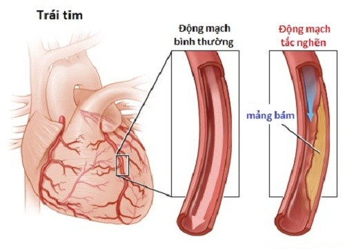 Nhịp tim nhanh và cách điều trị an toàn hiệu quả