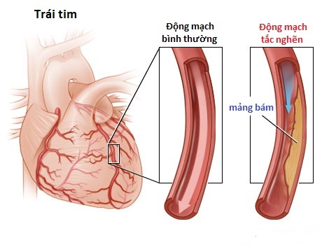 Nhồi máu cơ tim là gì nguyên nhân và cách phòng bệnh ra sao