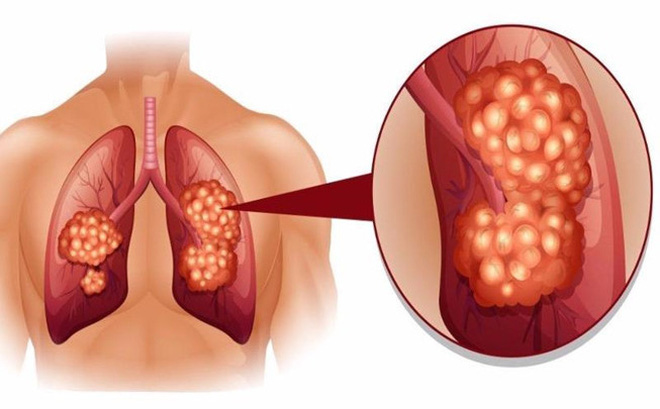 Những món ăn dành cho người bị ung thư phổi như thế nào