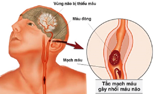 Phác đồ điều trị thiểu năng tuần hoàn não như thế nào