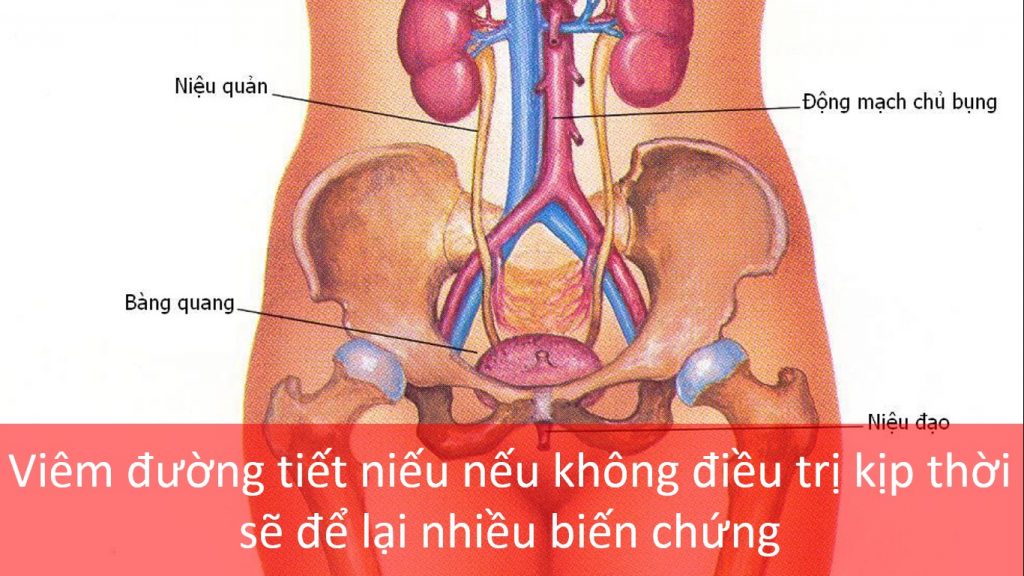 Phác đồ điều trị viêm đường tiết niệu như thế nào