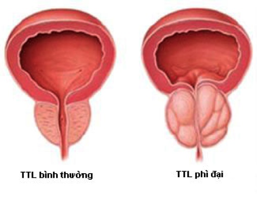 Phì đại tiền liệt tuyến là gì và cách phòng điều trị bệnh ra sao