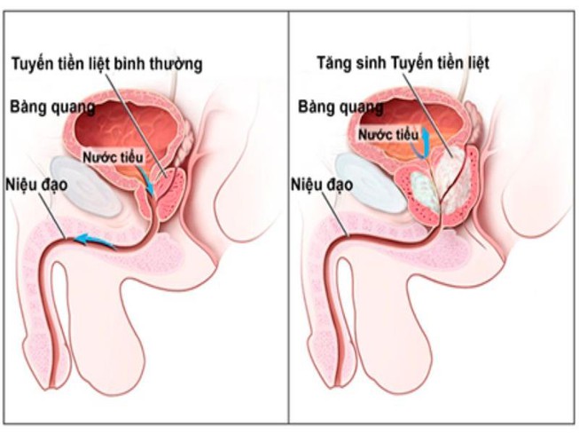 Phì đại tiền liệt tuyến uống thuốc gì?