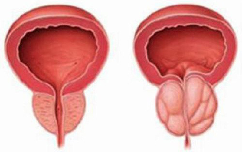 Phì đại tuyến tiền liệt cách nhận biết và phương pháp điều trị