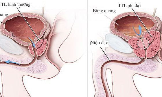 Phì đại tuyến tiền liệt cách nhận biết và phương pháp điều trị