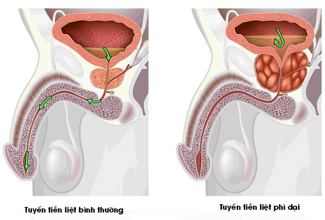 Phì đại tuyến tiền liệt uống gì tốt cho bệnh