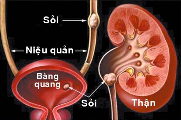 Sỏi bàng quang có nguy hiểm không