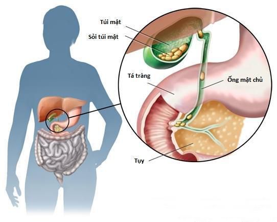 Sỏi mật có nguy hiểm không