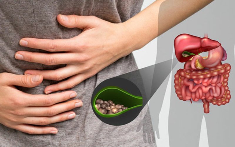 Sỏi mật kích thước bao nhiêu phải mổ