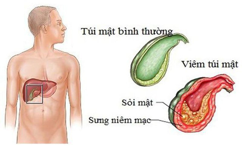 Sỏi mật kích thước bao nhiêu phải mổ