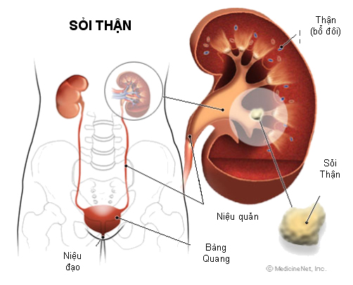Sỏi niệu quản và cách điều trị an toàn hiệu quả