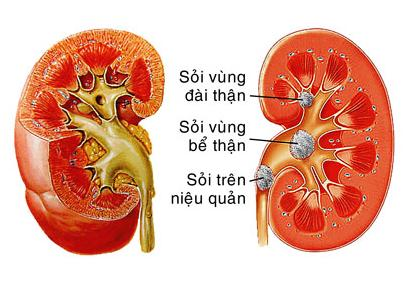 Bệnh sỏi thận nguyên nhân, triệu chứng và cách điều trị sỏi thận