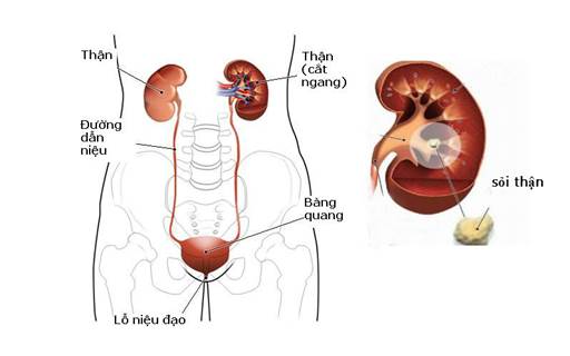 Bệnh sỏi thận uống thuốc gì tốt nhất hiện nay