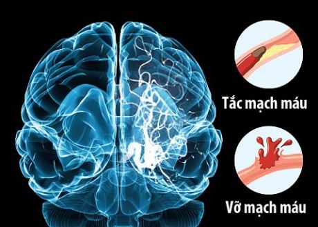 tai biến mạch máu não