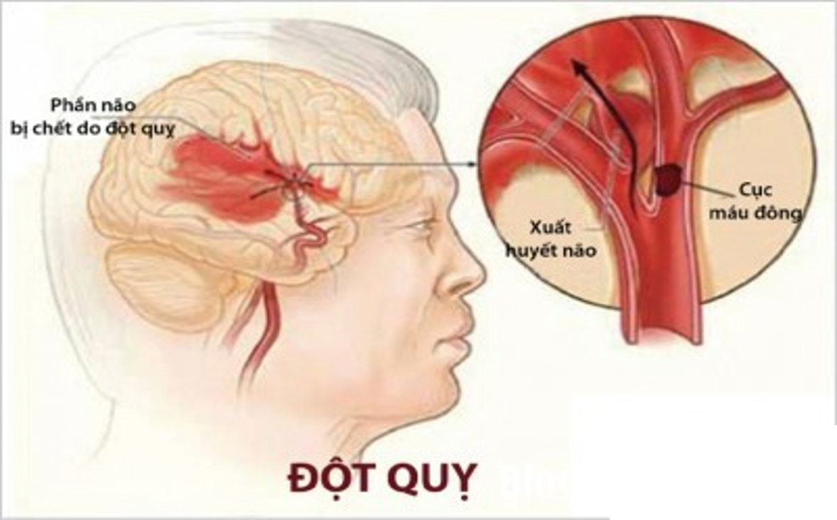 tai biến mạch máu não