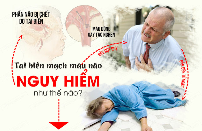 Tai biến mạch máu não là gì