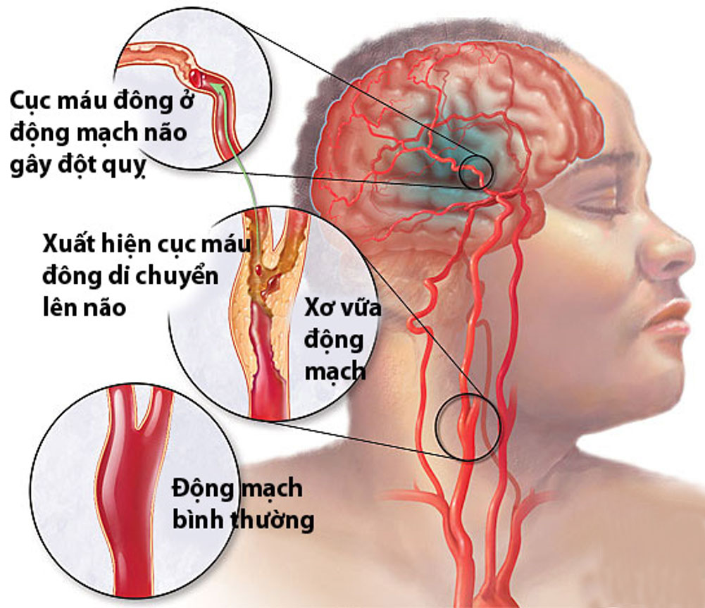 Tai biến mạch máu não