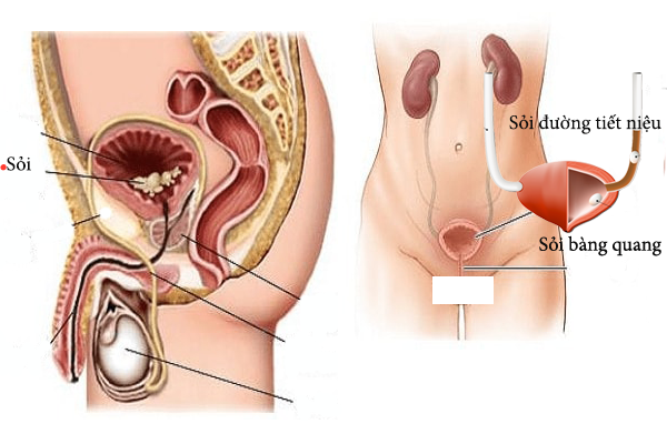 Tán sỏi bàng quang ở đâu tốt