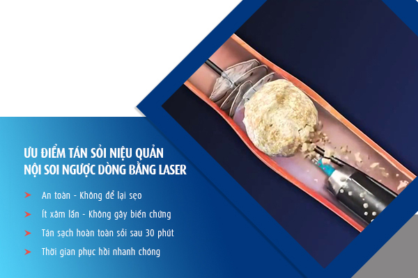 tán sỏi thận hết bao nhiêu tiền