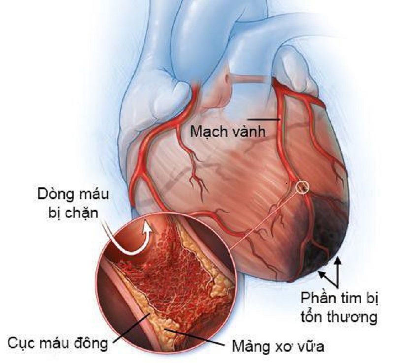 Thiếu máu cơ tim - Cách phòng ngừa và điều trị