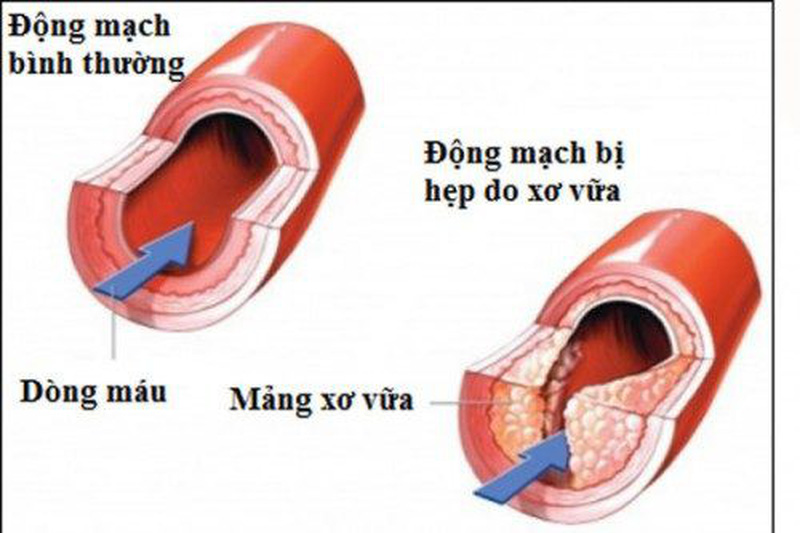 Thiểu năng tuần hoàn não có chữa khỏi được không