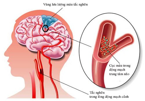 Thiểu năng tuần hoàn não là gì và cách phòng bệnh ra sao