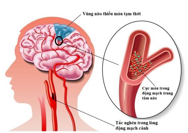 Thiểu năng tuần hoàn não nên uống thuốc gì hiệu quả nhất