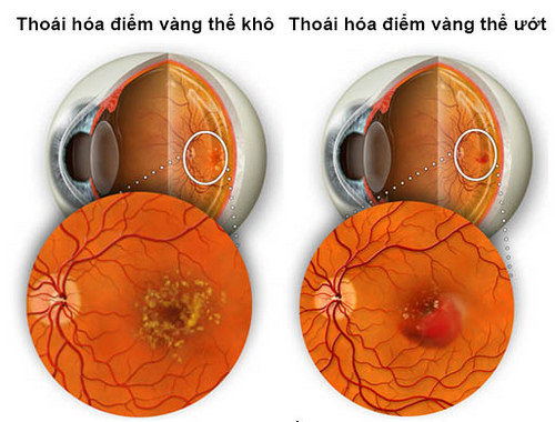 Thoái hóa điểm vàng có chữa được không