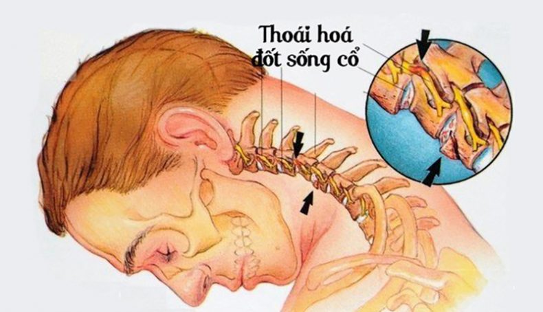Thoái hóa đốt sống cổ nên ăn gì tốt cho bệnh