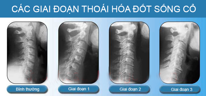 Bệnh thoái hóa đốt sống cổ là gì, nguyên nhân và cách điều trị