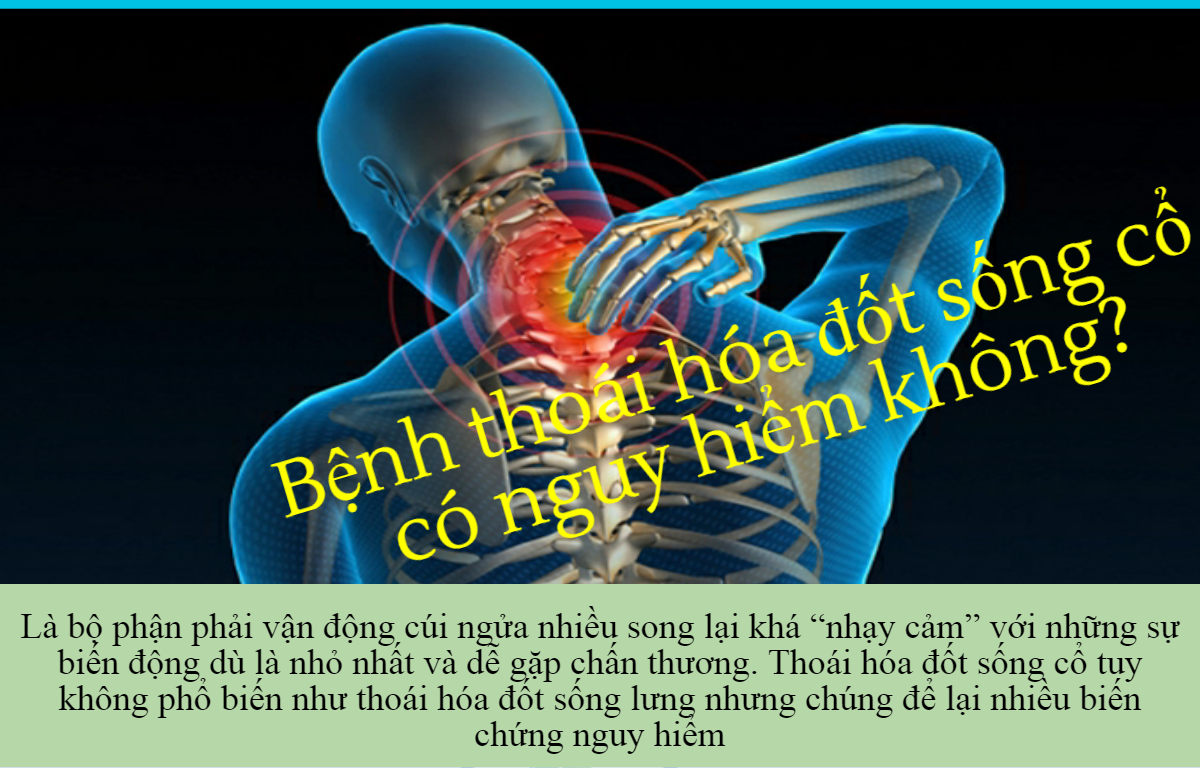 Bệnh thoái hóa đốt sống cổ và các câu hỏi về bệnh