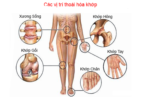 các vị trí bị thoái hóa