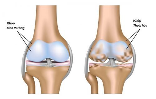 Thoái hóa khớp gối có nên đi bộ không và cách điều trị bệnh