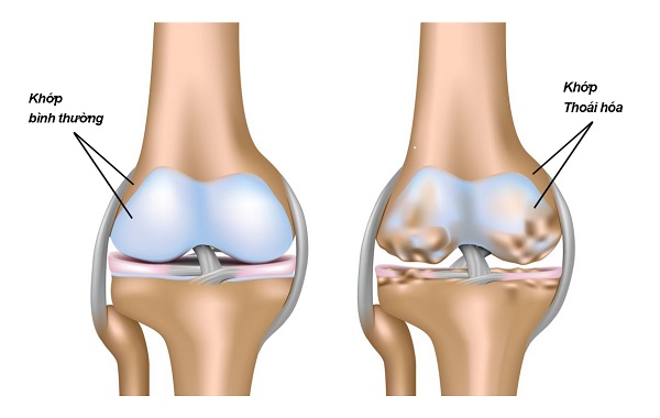 thoái hóa khớp gối nên ăn gì tốt cho bệnh