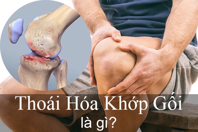 Thoái hóa khớp gối uống thuốc gì an toàn hiệu quả
