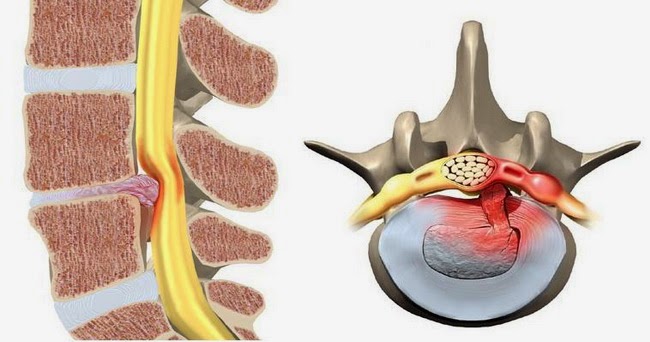 Thoát vị đĩa đệm ăn gì tốt nhất