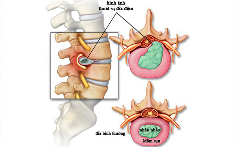 Thoát vị đĩa đệm - các liệu pháp dự phòng và điều trị