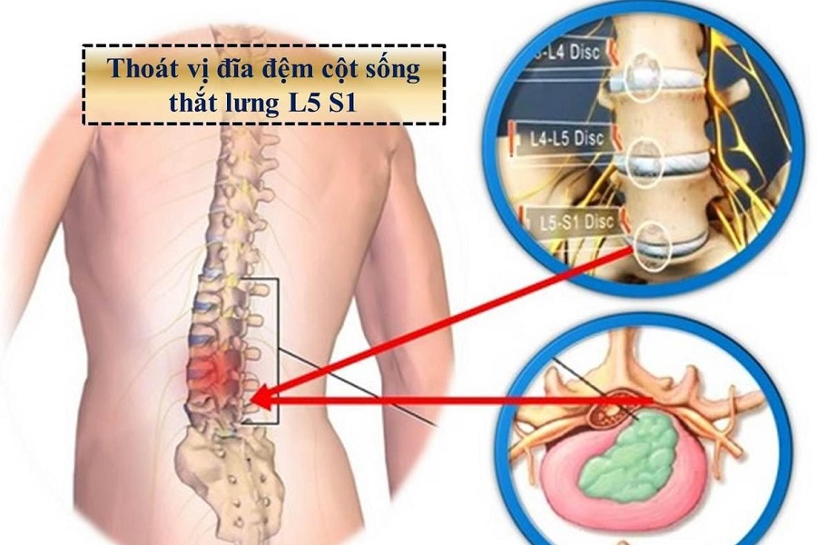 Thoát vị đĩa đệm cách nhận biết và phương pháp điều trị