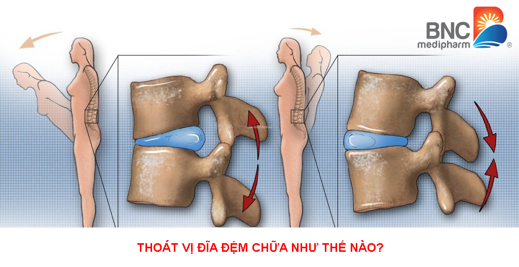 thoát vị đĩa đệm chữa như thế nào